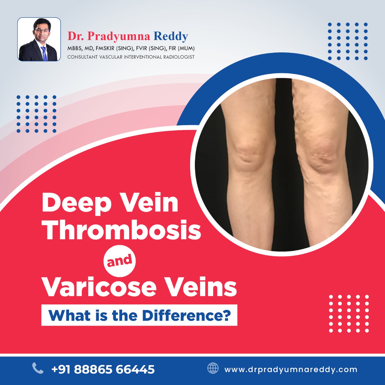 Deep Vein Thrombosis (DVT) - Vein & Endovascular Medical Care
