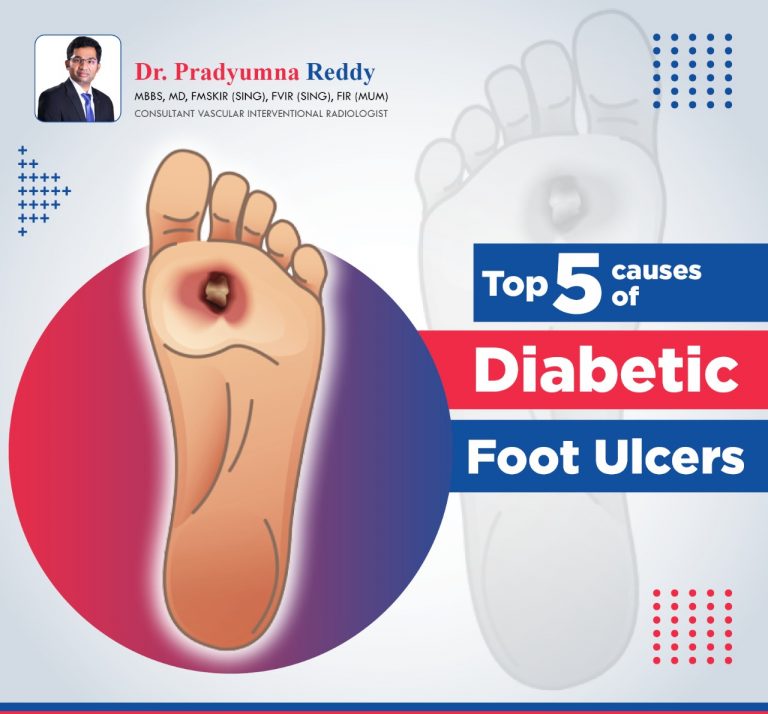 Top 5 causes of Diabetic Foot Ulcers