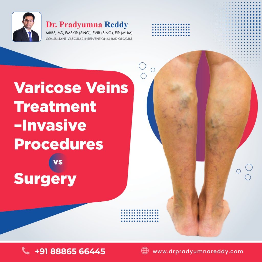 Causes For The Recurrence Of Varicose Veins After Treatment 