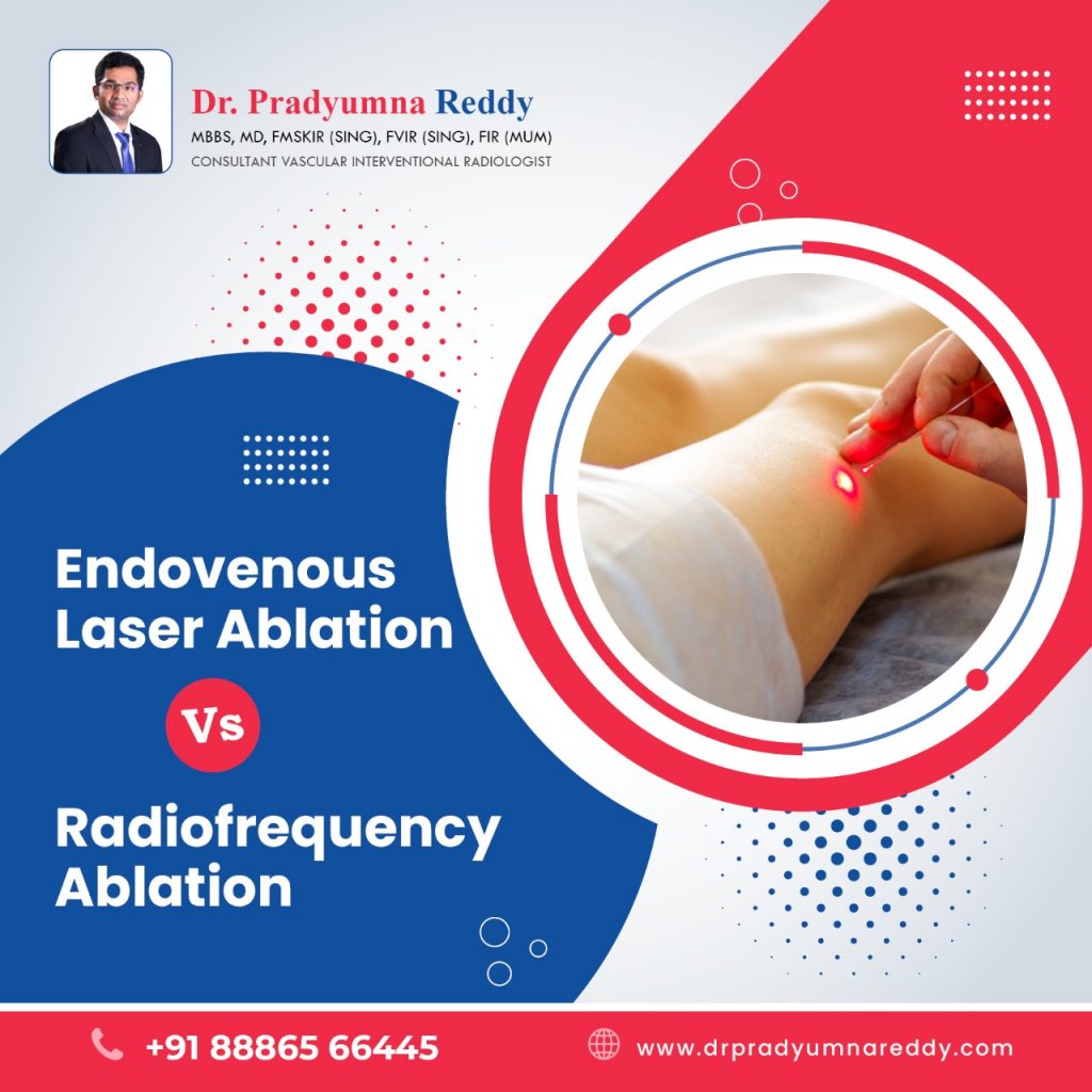 Endovenous Laser Ablation Versus Radiofrequency Ablation