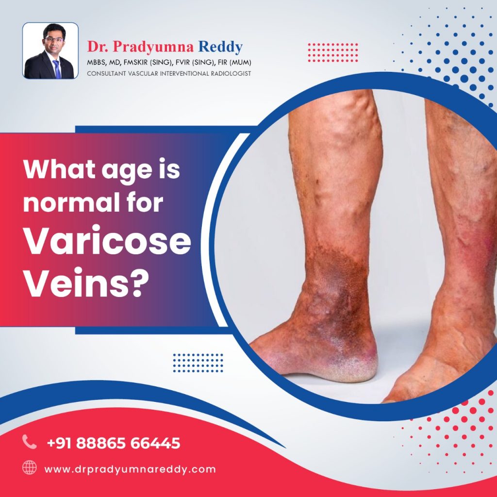 What Age is Normal for Varicose Veins?