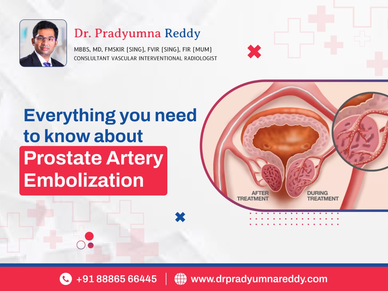 Prostate Artery Embolisation Surgery In Hyderabad Dr Pradyumna Reddy