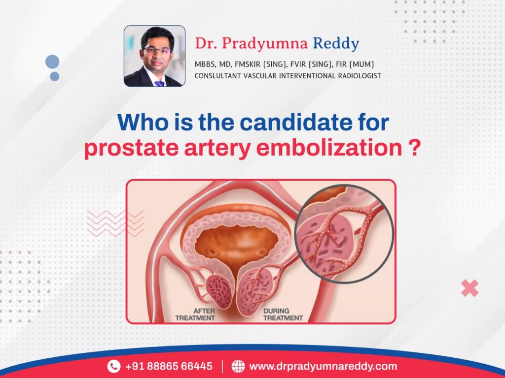 Who Is The Right Candidate For Prostate Artery Embolisation