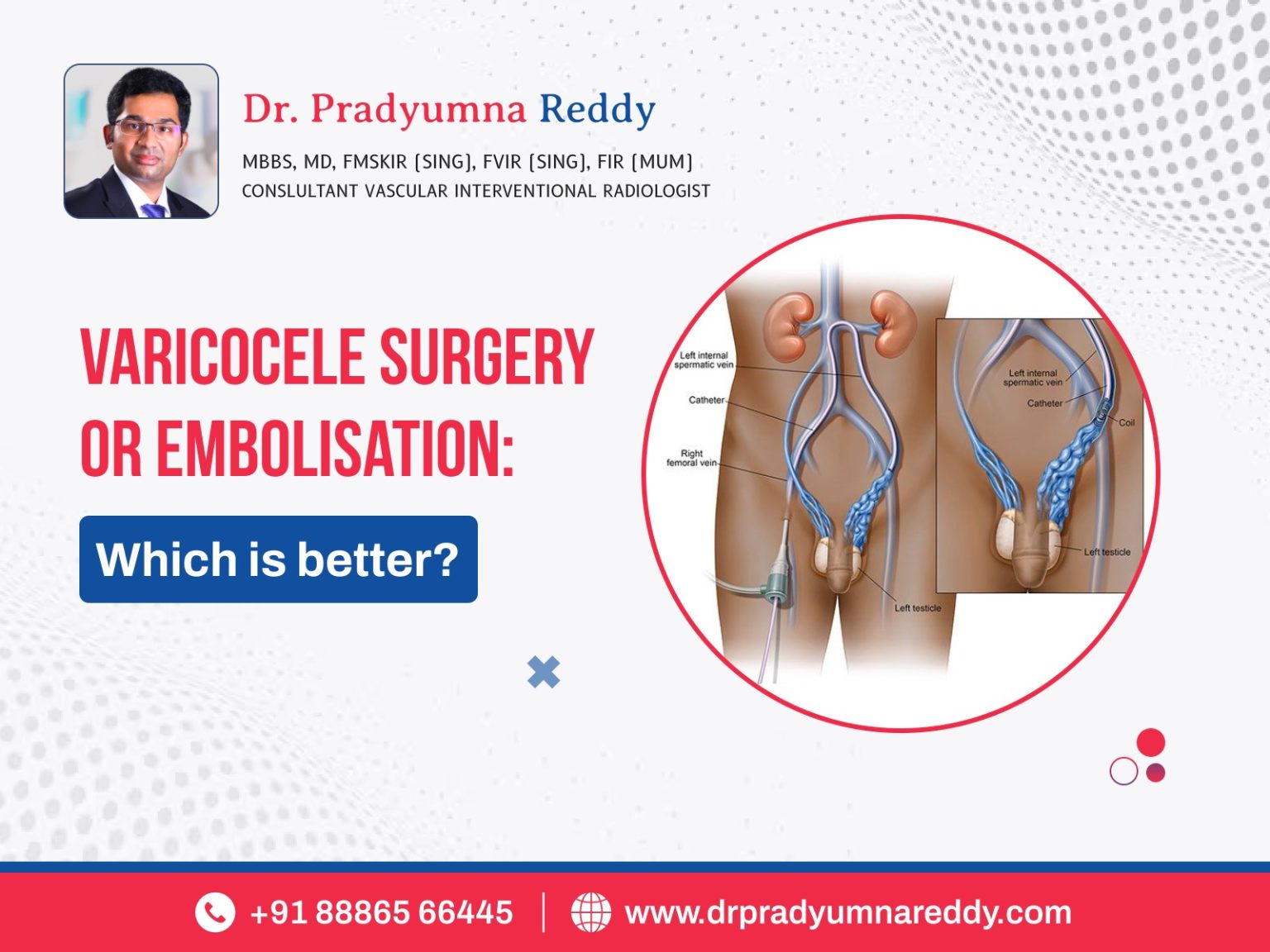 Varicocele Surgery Or Embolization Which Is Better