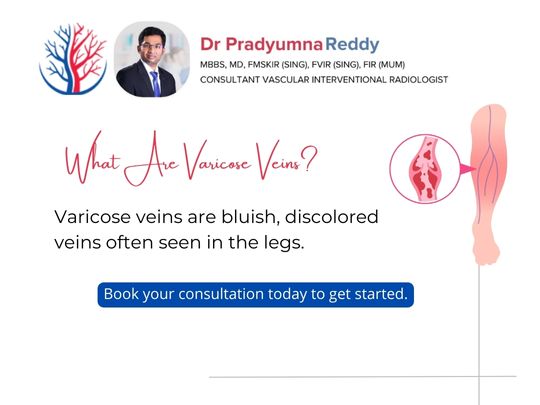 what are varicose veins? Are varicose veins easy to treat? Is there an alternative to surgery for varicose veins? Let's find out