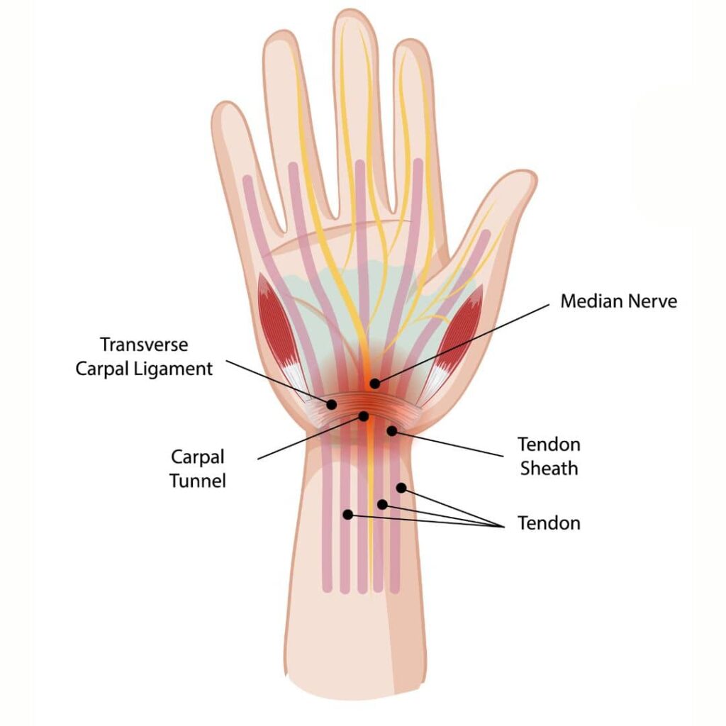 Call the number below to book a consultation and learn more about Carpal Tunnel Syndrome