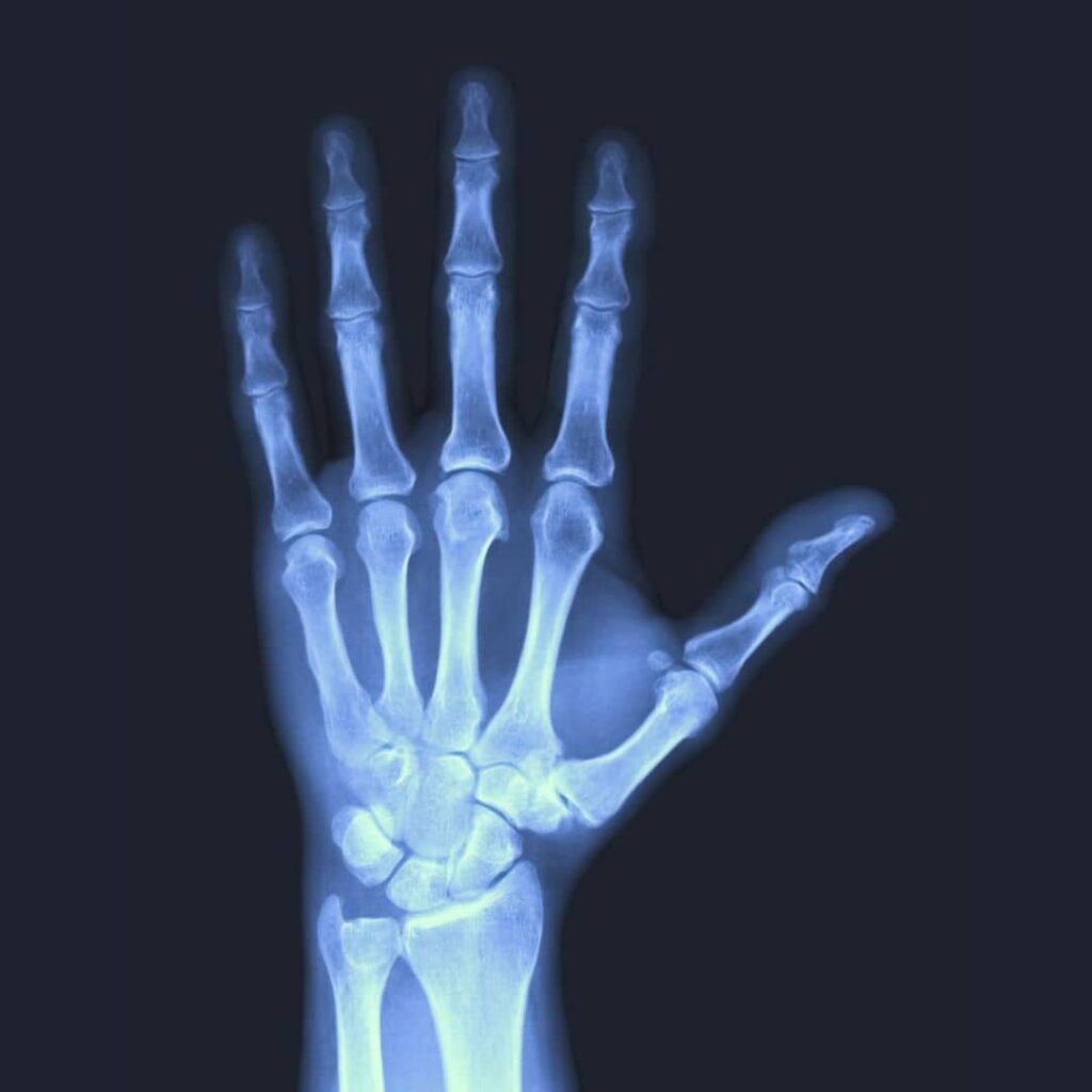 first step usually involves a wrist joint X-ray to rule out any bony abnormalities. Carpal tunnel syndrome